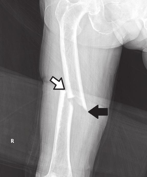 486 오현철 박성진 윤한국 Figure 1. (A) Preoperative radiograph shows an atypical diaphyseal femur fracture.