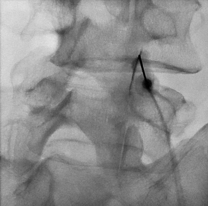 The synovial cyst and bulging disc lead to central canal stenosis. B.