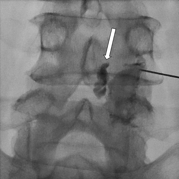 Anteroposterior facet joint arthrogram shows that the injection penetrated a facet joint synovial cyst (arrow), filling it completely. D.