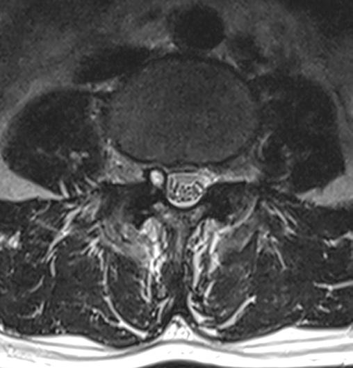 하지방사통을유발하는요추후관절활액낭종에대한투시유도스테로이드주사치료의단기효과 A B C D Fig. 2. A 47-year-old female with synovial cyst presenting right leg pain and low back pain. A. T2-weighted axial MR image obtained at the L4 5 level shows a 5 mm-sized hyperintense synovial cyst surrounded by well-demarcated hypointense wall.