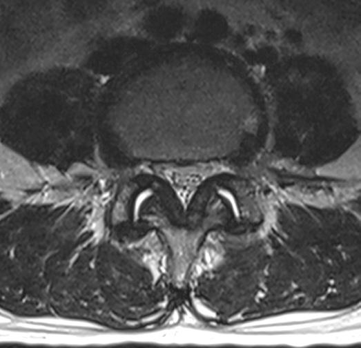 After injecting contrast media through right L4 5 facet joint, anteroposterior fluoroscopic image shows the synovial cyst filled with contrast media. D.