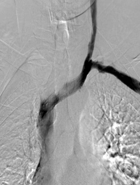 (B) Follow-up venography 16 hours after catheter directed thrombolysis for the left subclavian vein shows complete lysis of thrombus in the left subclavian vein but