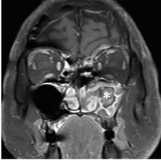inhomogenous mass (*) in left maxillary sinus