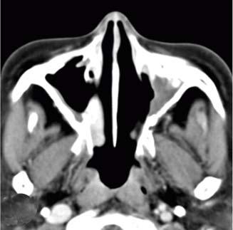 Paranasal sinus T scans of case 3 with