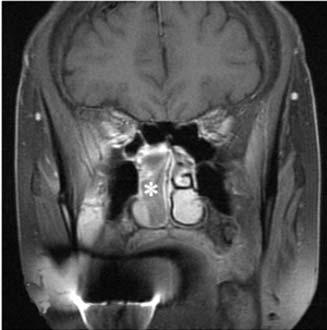 Paranasal sinus MRI of case 7 with