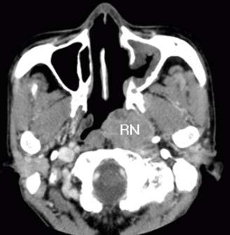 Slightly enhanced homogenous mass (*) is noted at left nasal cavity on axial () and coronal () view.