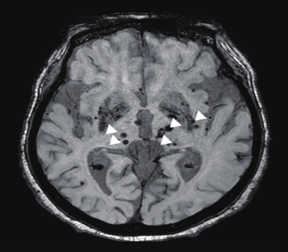 3D-T1 weighted image and Fluid-attenuated inversion recovery (FLAIR) image showing multiple lacunes in brain (C, D).