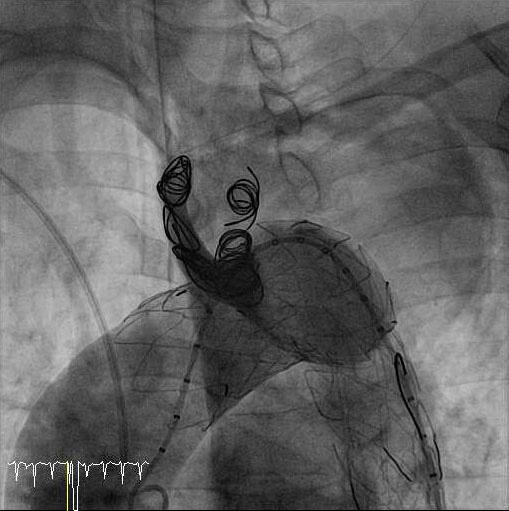 Shunt blood flow, from the left carotid artery to the left subclavian artery, was intact.