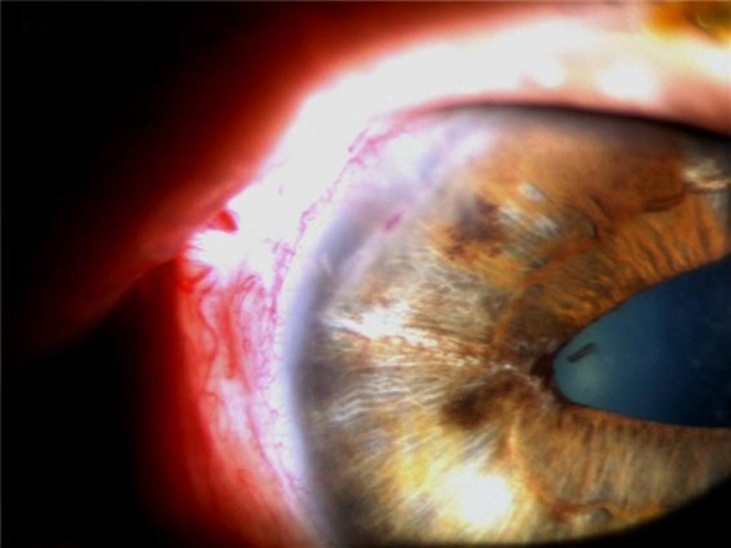 (C) before PPKP: Severely edematous cornea and corneal haziness are shown. POD = Postop date; PPKP = penetrating keratoplasty. 을보였다. 이를바탕으로포도막염속발녹내장, 푹스홍채이색섬모체염진단하에최대약물치료로안압조절이되지않아아메드밸브삽입술을시행하였다.