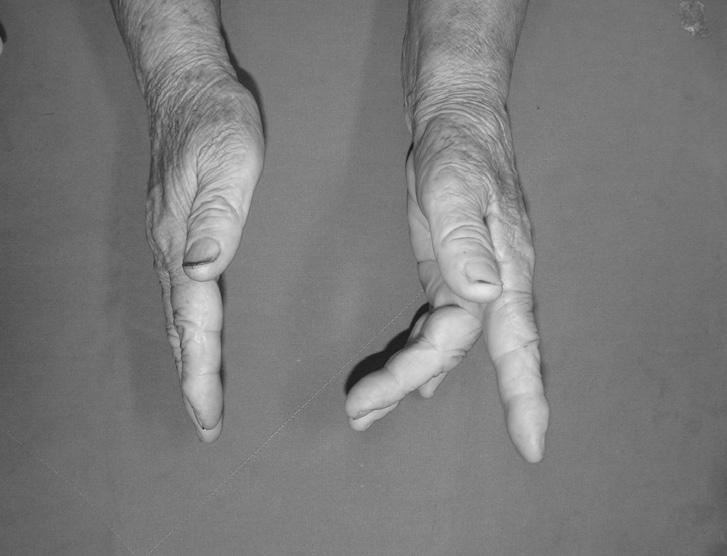 extension lag of the right third and fourth fingers (B). A B C Figure 2.