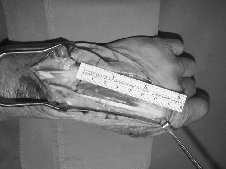 방사선검사에서원위요골의부정유합과월상골의키엔벡병이확인되었고, 월상골은분절화되어후방골편이유두골근위부의후방으로전위되어있었다 (Fig. 2).