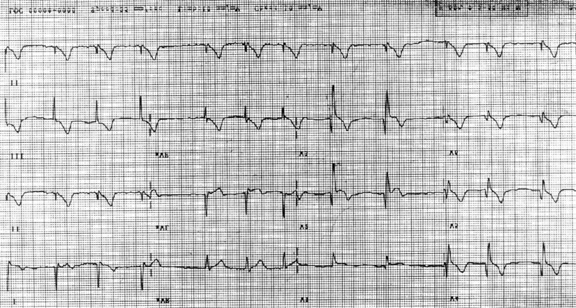 79, activated partial th- 를 진단하고 경피적 풍선 확장술과 bciximab(reopro ) romboplastin time 23.9 sec 이었다. 그 외에 homo- 정주 요법을 이용하여 성공적으로 치료한 경험을 보고 cysteine 10.45(mol/L, erythrocyte sedimentation 한다.