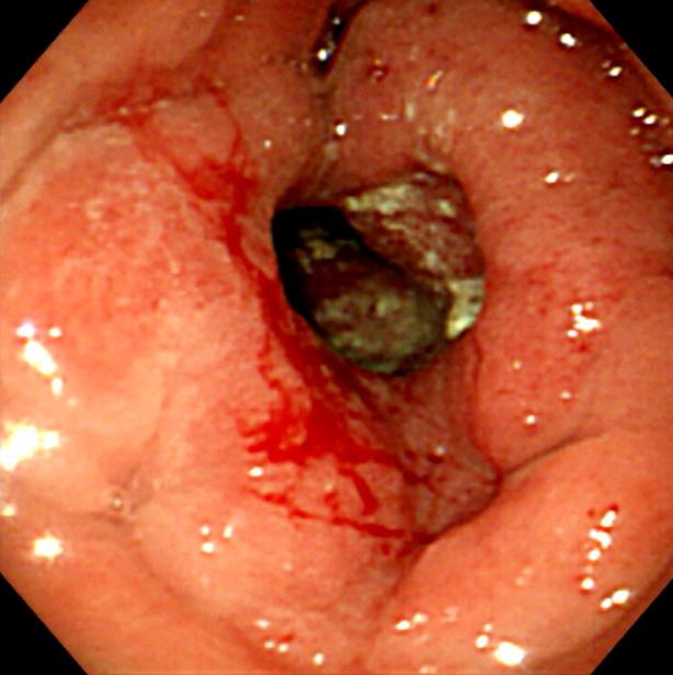 이윤정, 이준행 : 위장관림프종 163 7. 버킷림프종 (Burkitt lymphoma) Fig. 6. Burkitt lymphoma of the stomach. 나쁜질환이다 (Fig. 4). 삼성서울병원에서경험한원발성위장관 NK/T-세포림프종 14예중내시경사진을확보할수있었던 11예 ( 위 3예, 식도 2예, 십이지장 1예, 대장 5예 ) 를분석하였다.