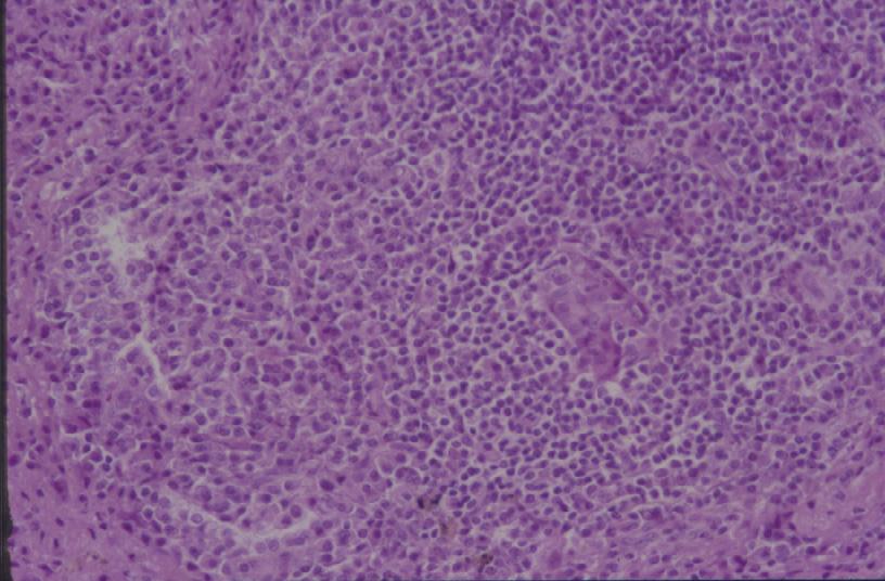 Some cells show plasmacytic differentiation (left side) ( 200). (C) Immunohistochemically, they reveal positive reactivity for CD20 ( 100). 구 (posterobasal segment) 주변부로 2.