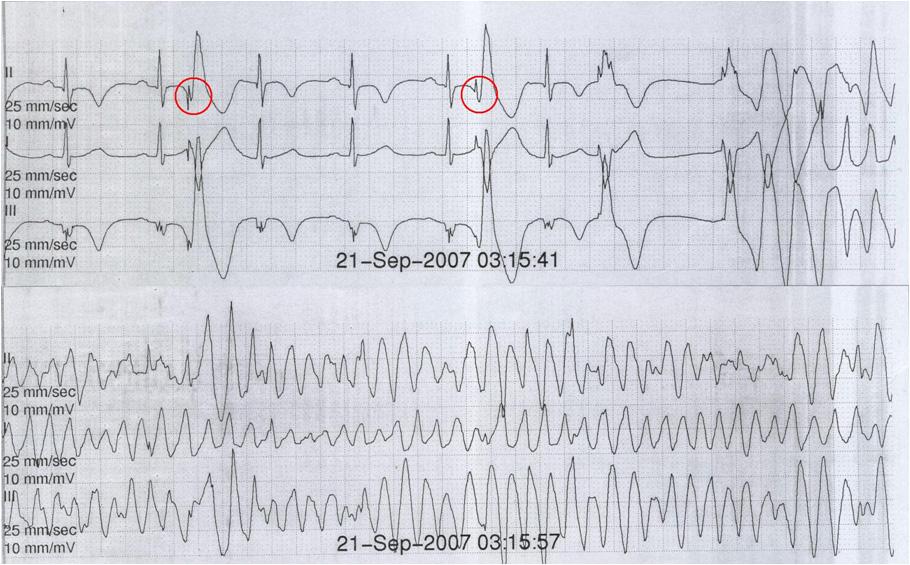 Electrocardiography performed in the coronary care unit showed pacing-permitted polymorphic ventricular tachycardia following a short-long-short sequence.