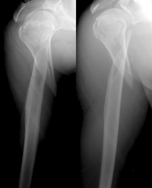 (A) Preoperative radiographs show fracture of the proximal 1/3  th (B)