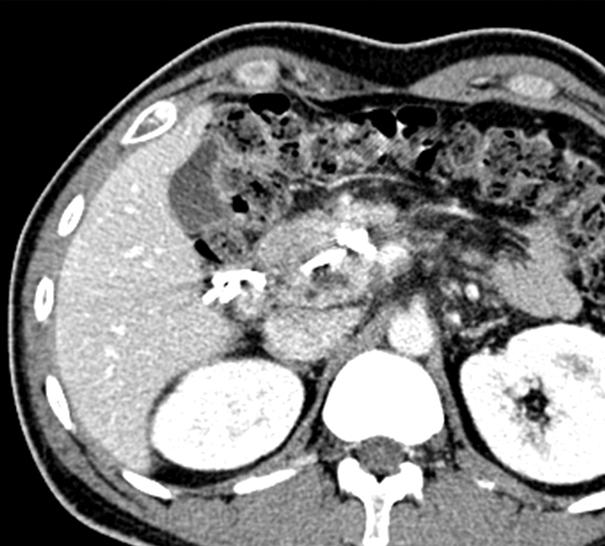 중재적 내시경초음파 시술 송태준ㆍ서동완 Figure 3. EUS-guided cystoduodenostomy. (A) A pseudocyst is formed in the space between duodenum and pancreas head.