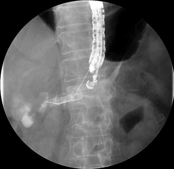 (B) A guidewire was inserted into the MPD and the passage of the guidewire into the anastomotic margin was difficult. (C) A needle-knife was passed through the puncture tract over the guidewire.