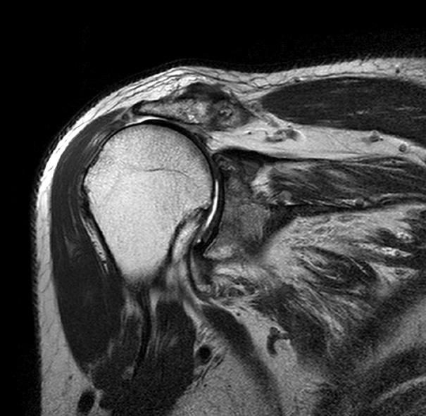 65 광범위회전근개파열의치료 Figure 1. (A) Pre-operative magnetic resonance imaging shows a massive rotator cuff tear with severe tendon retraction and (B) fatty degeneration.