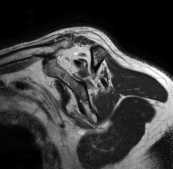 (D) Rotator cuff tendons could not be restored to the original footprint, despite of mobilization; therefore partial repair was performed.