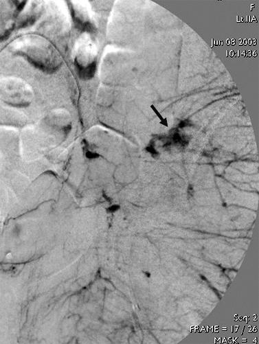 344 박기철 Fig. 4. Fluoroscopic images (A) showing extravasation of contrast (arrow) in a internal iliac artery injury, which is the controlled with angiographic coiling (B).