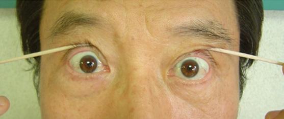 내원당시시행한신경학적검사에서왼쪽눈의내측및상방주시에제한이있고안구진탕이동반되었으며왼쪽눈의안검하수가있었으나 (Figure 1A D)