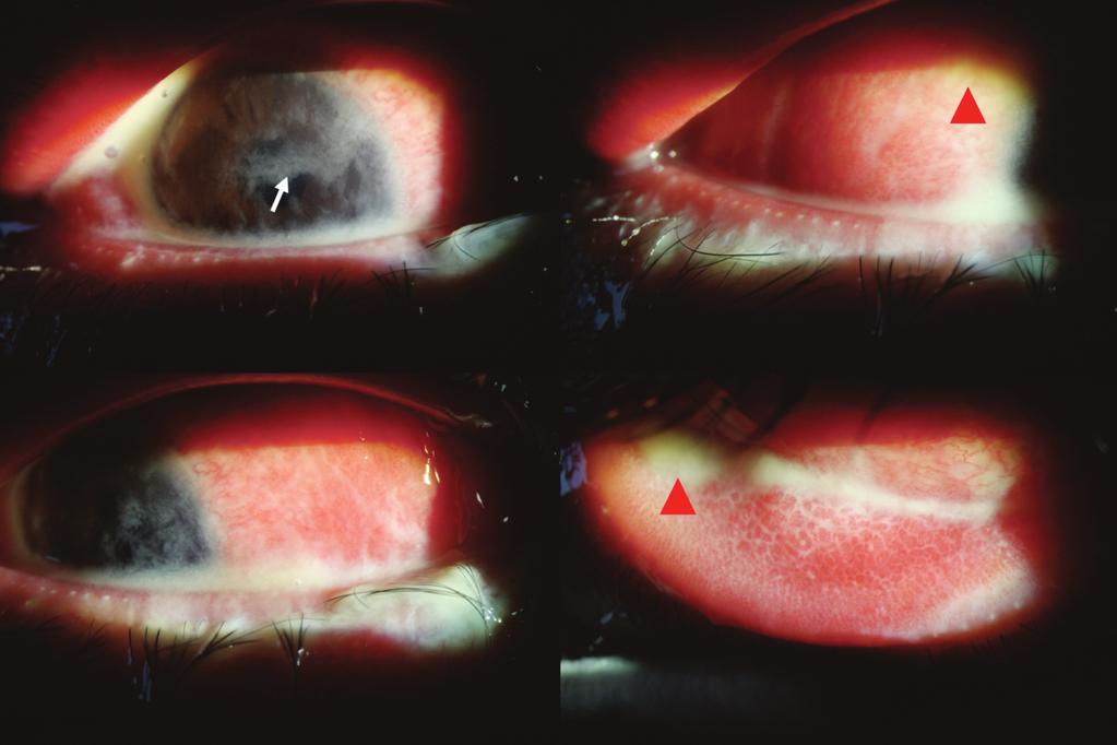성인에서발생한임균성결막염 103 A B C D Fig. 1. Photographs at 4th day after the 0.5% loteprednol eye drop was used. (A) Cornea surface covered with yellow-white thick purulent ocular discharge (arrow).