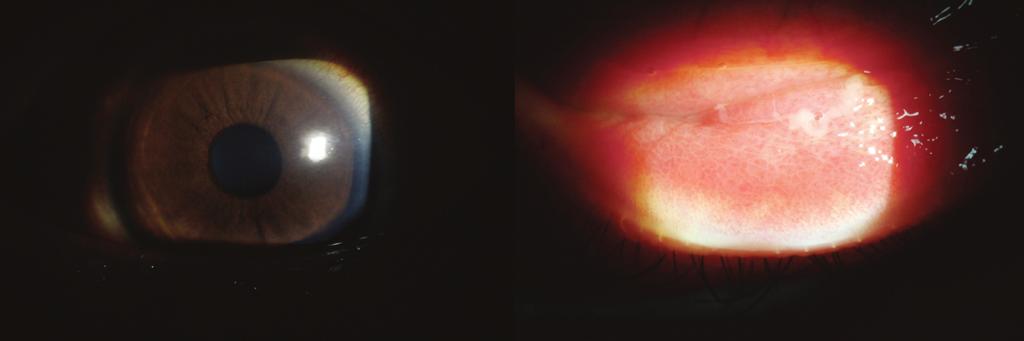 diplococcic (x1000, oil immersion). A B Fig. 3. Photographs at 3rd day after the 3rd-generation cephalosporin antibiotic was used systemically.