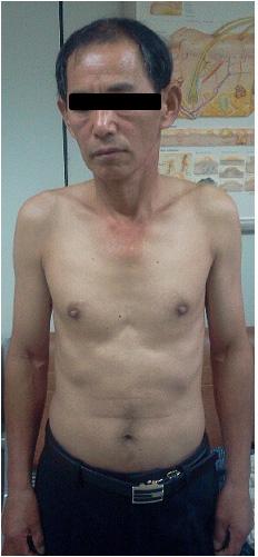 94 Psoriasis Treated with Soeumin Goepoong-san 다.(Figure. 1) 2) 사상체질설문지 QSCC 소양인 > 소음인 3) 소증 (1) 수면 : 불면 (2) 대변 : 별무이상 (3) 소변 : 별무이상 (4) 식사, 소화 : 미약한소화장애 (5) 땀 : 별무이상 (6) 설진 : 담홍설백이태 (7) 갈증 : 별무이상 Ⅲ.