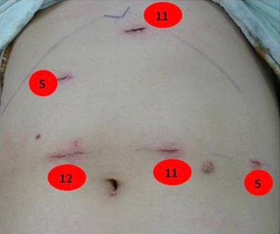 Jung Ho No, et al:laparoscopic Sleeve Gastrectomy 461 으로인식하고적극적으로치료해야할시점에도달했다고하겠다. 복강경도입후베리아트릭수술은급격히발달하여고도비만을치료하기위한다양한수술방법이시도되었다.