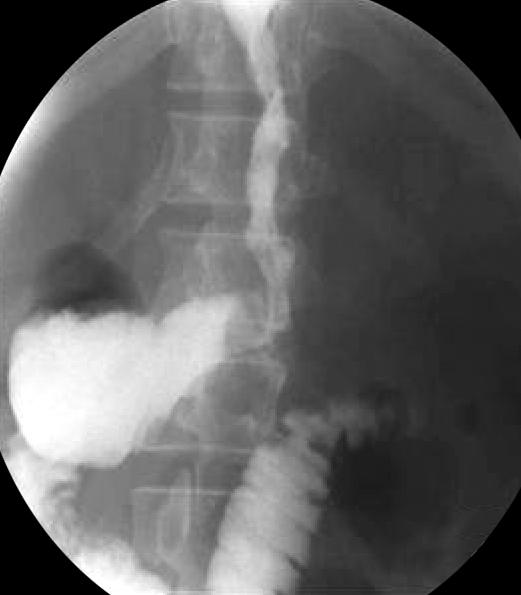 462 J Korean Surg Soc. Vol. 79, No. 6 Fig. 2. Resected gastric specimen (A) and water-soluble contrast swallow study on postoperative day 1 (B) were shown.