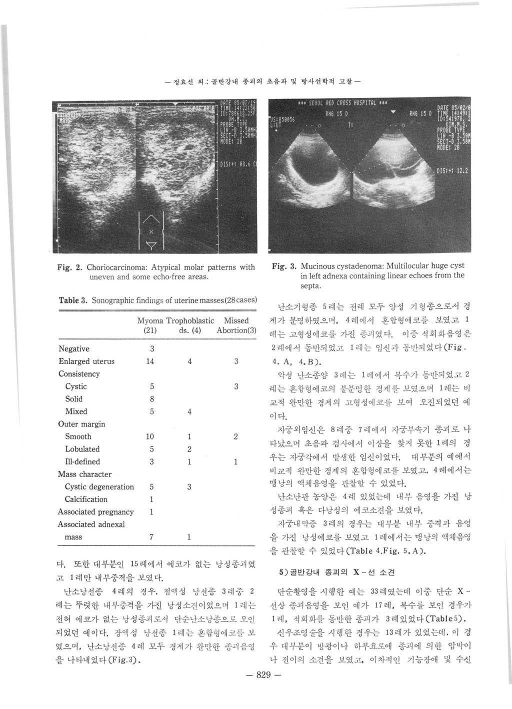 - 정효선외 : 골반강내종괴의초음파및방사선학적고찰 - Fig.. Choriocarcinoma: Atypical molar patterns with uneven and some echo.free areas. Table.
