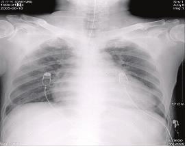 - 김소미외 6 인 : 혈액투석중발생한출혈성심장눌림증 1 예 - A B Figure 1. (A) Chest X-ray shows pneumonia of BLF. (B) Chest X-ray shows cardiomegaly. A B Figure 2.