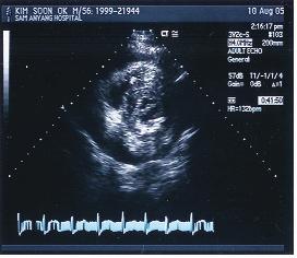 (A) Parasternal long-axis view shows a moderate amount of pericardial effusion and right ventricular collapse.