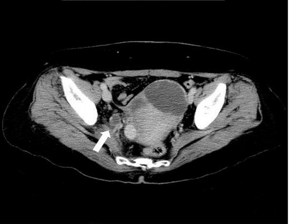 41 L (예측치의 104%), FVC A B C D Figure 1. (A) The chest X-ray shows centrilobular nodules in both lung fields, predominantly in the lower lungs.