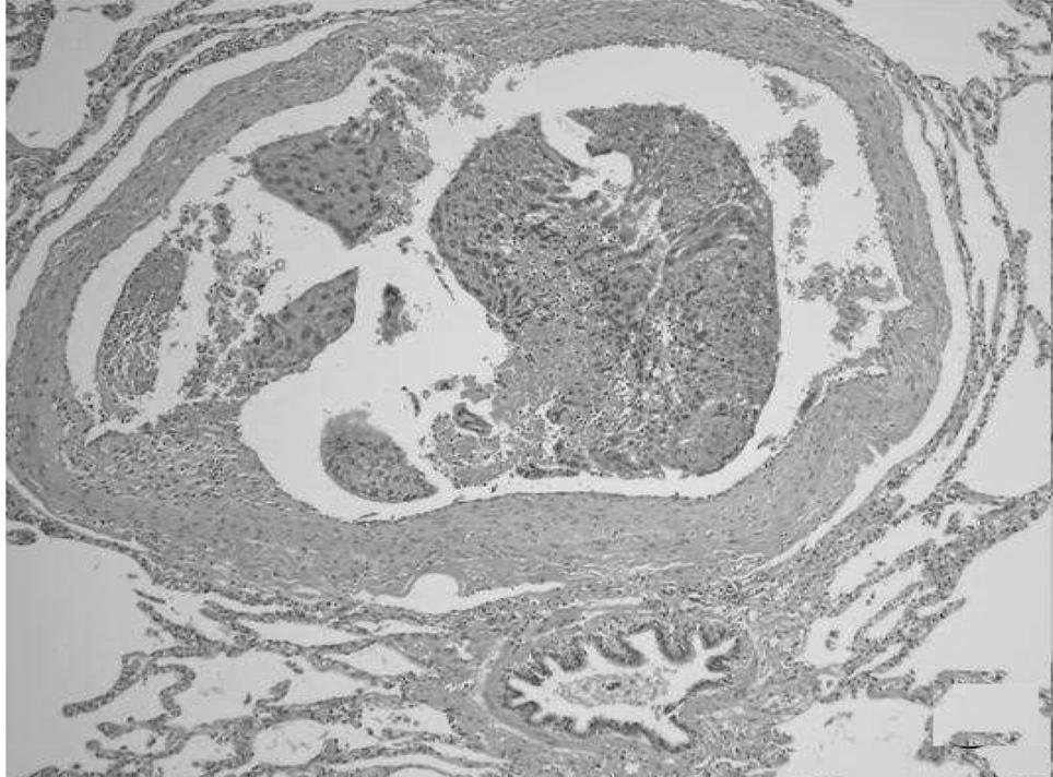 Mi Hyun Kim, et al. Pulmonary choriocarcinoma presenting as multiple centrilobular nodules 2.89 L (예측치의 93%), FEV1/FVC 83%였으며 DLCO는 예측 보이지 않았다. 치의 81%로 정상소견을 보였다.