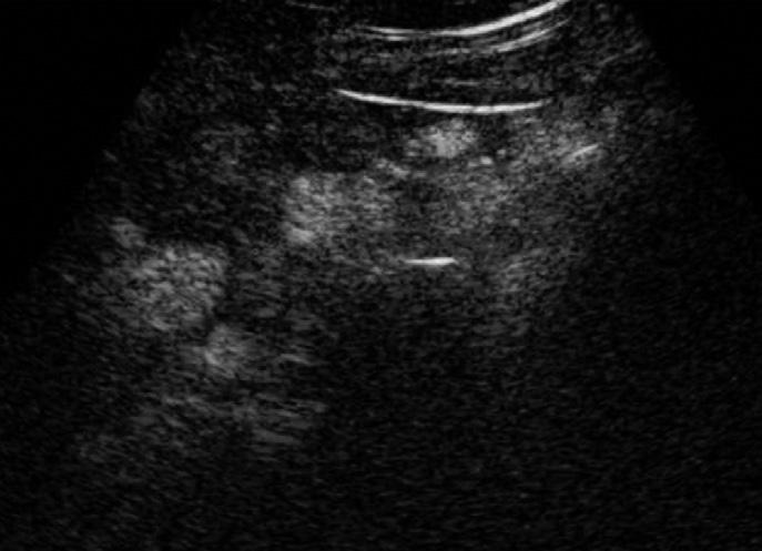 gastrohepatic and hepaticoduodenal ligaments, and mesenteric areas and fissure for ligamentum teres (E).