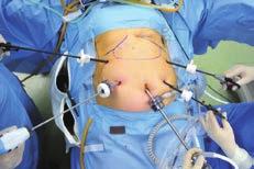 of anastomosis Gastric cancer surgery Approach open Laparoscopy/robot 의 : 통 (0.5-1.