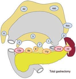2014 외과전공의연수강좌 (Unit 2) 암의 Distal Gastrectomy Roux-en Y Gastro-jejunostomy 암의 Total Gastrectomy 0 : Lymphadenectomy