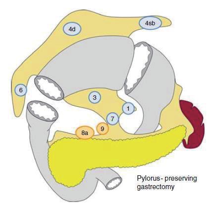 암의 Proximal Gastrectomy 0 : Lymphadenectomy less than D1 D1 1,2,3,4sa,sb,7