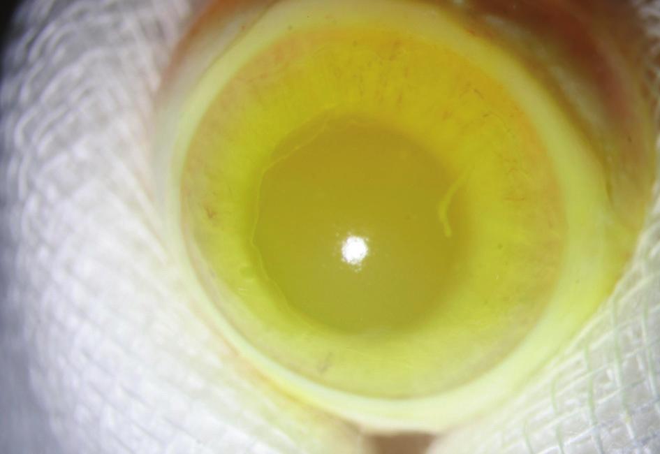 대 한 안 과 학 회 지 2008년 제 49 권 제 12 호 A B Figure 2. Photographs of corneal epithelial defects at 4 days after contact lens wear. (A) Large epithelial defect (grade 3) is shown in the color lens 1 group.