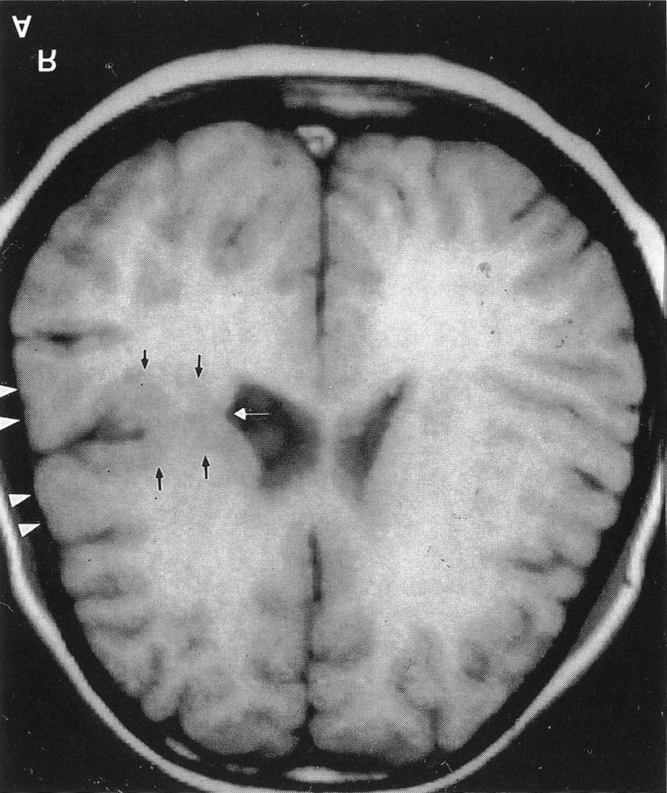 송홍기 고임석 박세혁 외 Table 2. Epileptic features and EEG findings in the reported patients Casea Epilepsy Age at onset Seizure type EEG findings Medication Frequencyb 1. t done 2. t done 3.