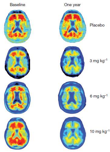 Nature Published online 11 July 2016 1. 반아밀로이드항체아두카누맙의효과 ( 계속 ) Amyloid plaque reduction with aducanumab: example amyloid PET images at baseline and week 54.