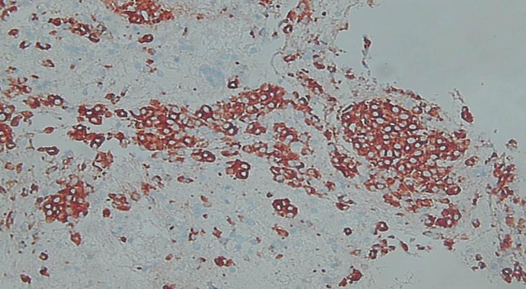 () The pancreatic neuroendocrine tumor (NET) has a typical plasmacytoid appearance (propidium iodide, 10).