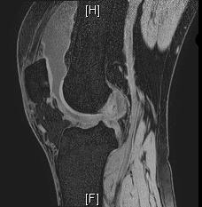 - Hee Jin Park, et al. Candida parapsilosis infectious arthritis in patient with ulcerative colitis- A B Figure 2. Magnetic resonance images of the right knee showing joint effusion with synovitis.