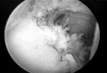 : Capsular laxity was present in preoperative arthroscopy. : Capsular plication was performed with a transglenoid suture technique. 으며 (Fig.