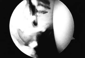 견관절전방불안정성과관련된다양한병변 117 Mid-capsular tear Mid-capsular tear PO Fig. 3. : mid-capsular tear is shown in this arthroscopic view.