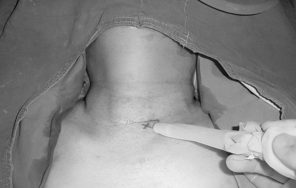 3mCi/kg의 99mTc sestamibi를 정 맥투여하고, 투여 30분경에 scan을 시행한 후에 수술을 시 작하였다. 전신 마취 하에서 환자의 목을 신전시킨 상태에 Fig. 1.