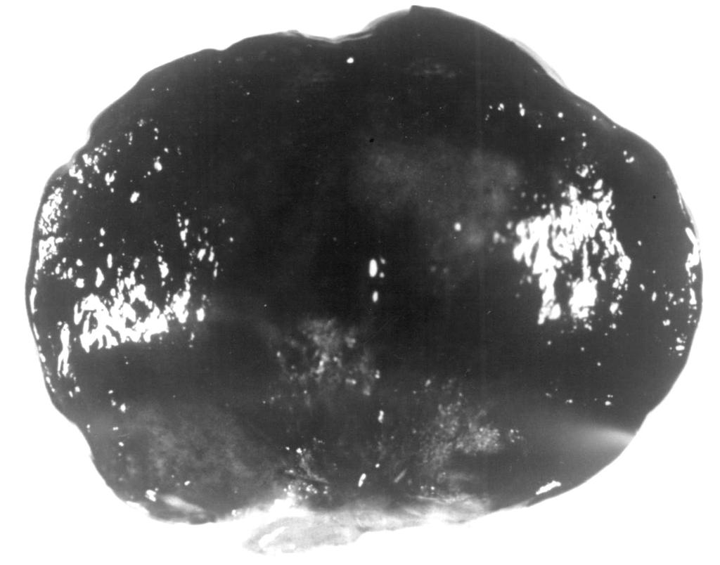 가 있었는데 폐색전증을 의심할만한 소견은 A C B Fig. 2. Transthoracic echocardiography of round and nonprolapsing type of atrial myxoma. A. Parasternal long axis view showed a mass typical of an atrial myxoma of round type characterized by solid, round shape with nonmobile surface (indicated by arrow).