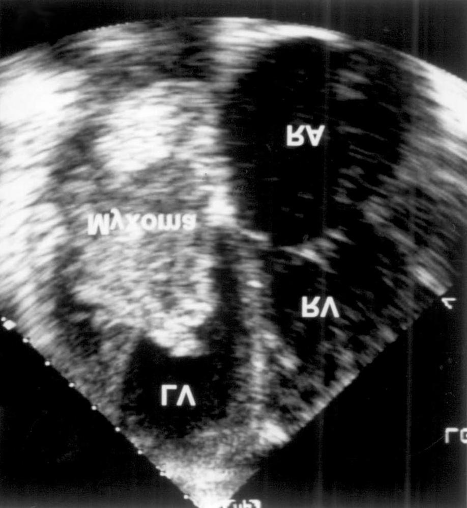 있었다(Table 2). 4명(8%)의 환자는 증상없이 선 합 심장 점액종으로 진단 받았다. 세균성 심내막염을 보 A B C Fig. 3.